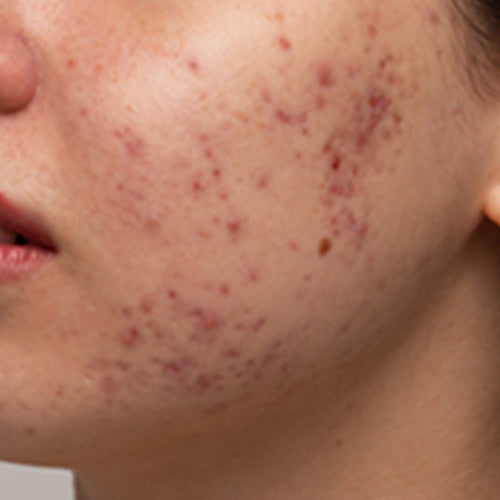 acne-scars