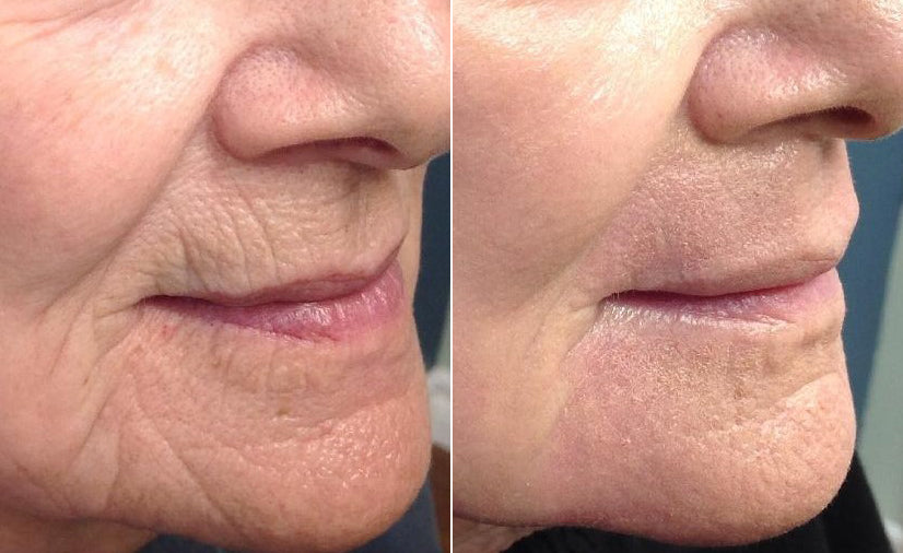 CO2 Laser Treatment - Laser skin resurfacing - Newfoundland, Canada