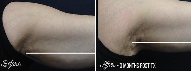 CoolSculpting Sudbury Skin Clinique Dermatologist Supervised Cosmetic Clinic Northern Ontario