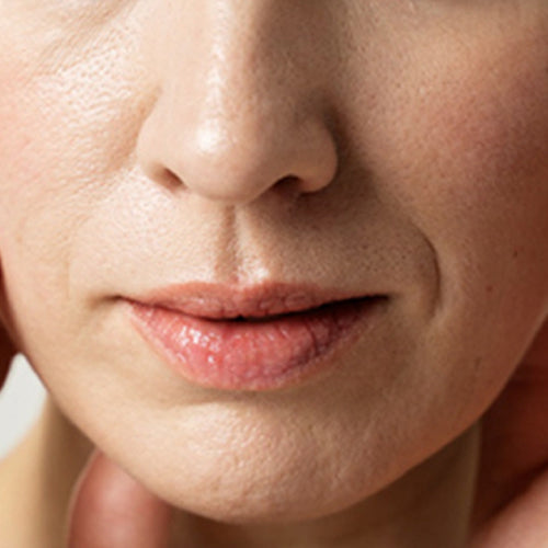 enlarged-pores