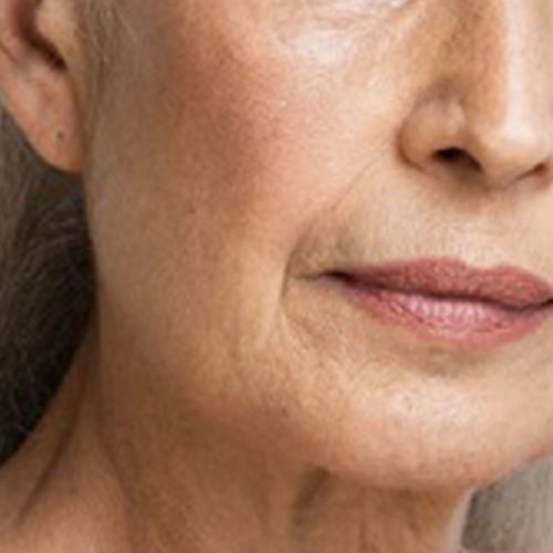 fine-lines-and-wrinkles