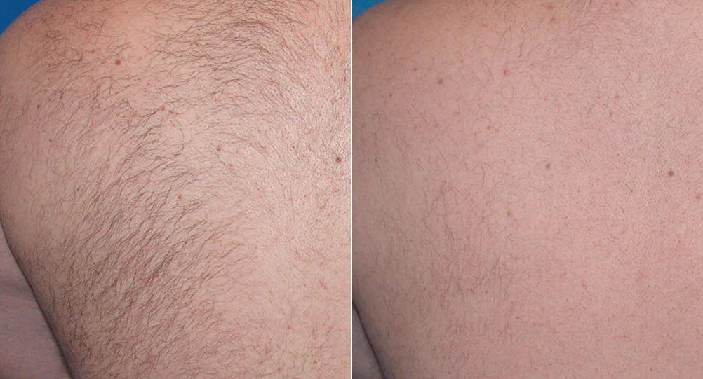 Hair Removal Sudbury Skin Clinique Dermatologist Supervised