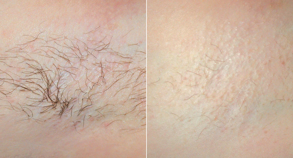 Hair Removal Sudbury Skin Clinique Dermatologist Supervised