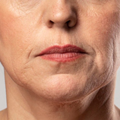 skin-laxity