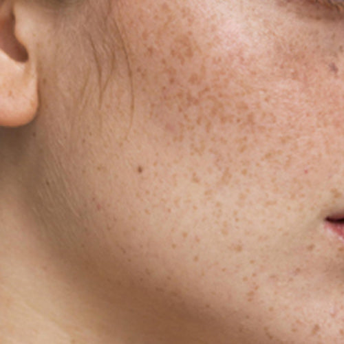 pigmentation-concerns
