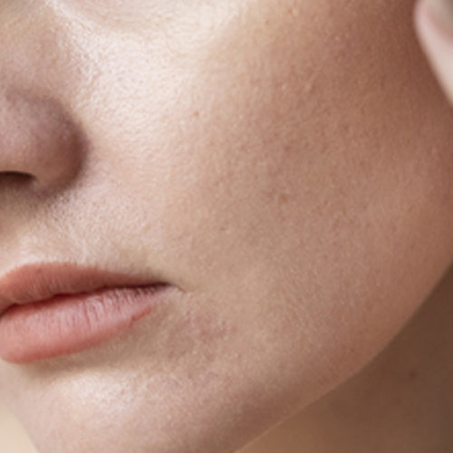uneven-skin-texture